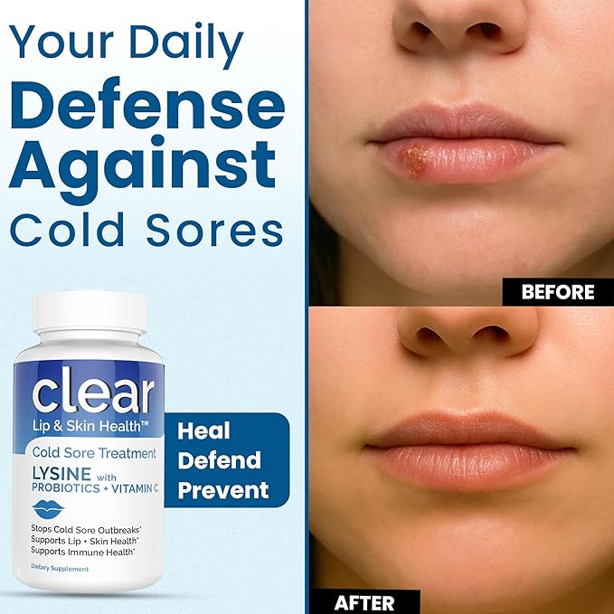 Lysine Cold Sore Treatment for Lips with Pre-Probiotics & VIT C | 3 Month Supply | Supercharged Lysine Capsules with Rhamnosus & Acidophilus for Cold Sores Relief, Skin + Gut Health & Immune Support