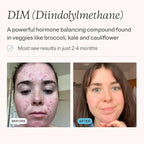 MDacne DIM Skin Clearing Supplements (90 Capsules) - for Acne Treatment, Estrogen Balance, Hormone Menopause Relief & Bodybuilding, Cruciferous Extract & Bioperine - Dermatologist Formulated (3 Pack)